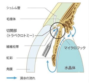 緑内障の手術治療 - 岡崎南 上地眼科クリニック